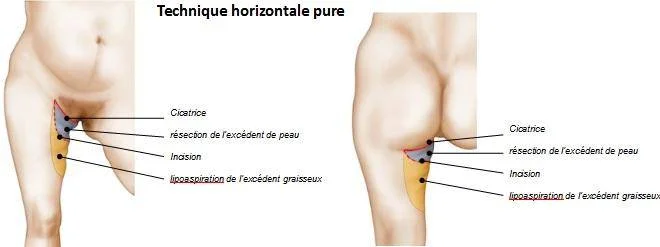 Procedure: Skin incisions and implant placement