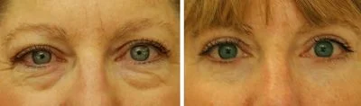 Result of eyelid cosmetic surgery: Blepharoplasty before and after photos: