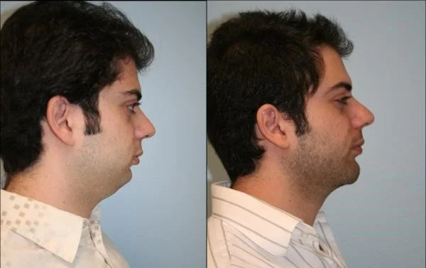 Genioplasty Tunisia: The result