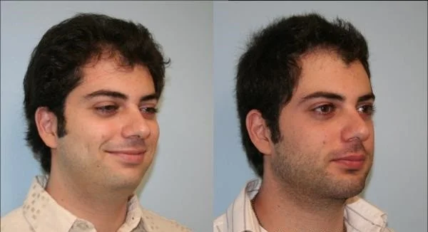 Genioplasty Tunisia: The result