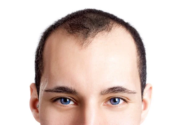 Hair transplant Tunisia: What you need to know