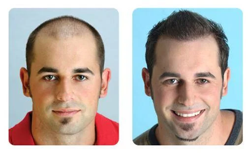 FUE hair transplant result