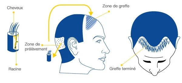 Hair transplant Tunisia: Procedure